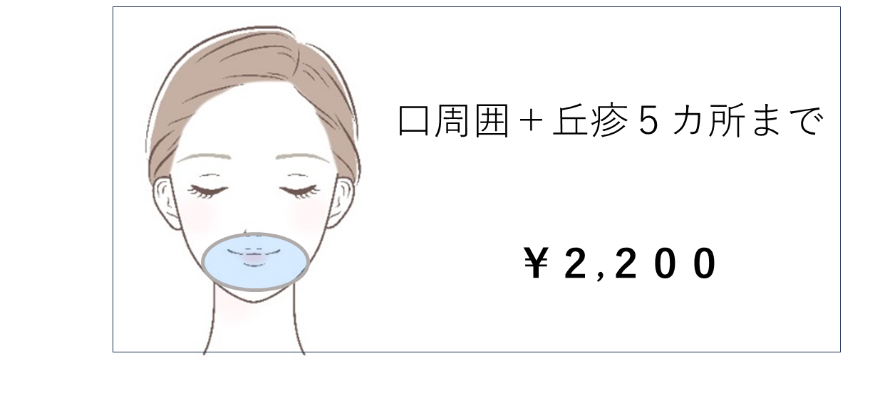 ブルーレーザー1 ブルーレーザー1