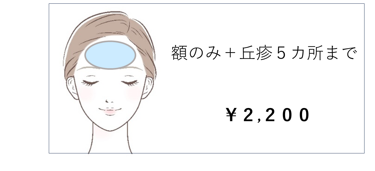 ブルーレーザー2 ブルーレーザー2