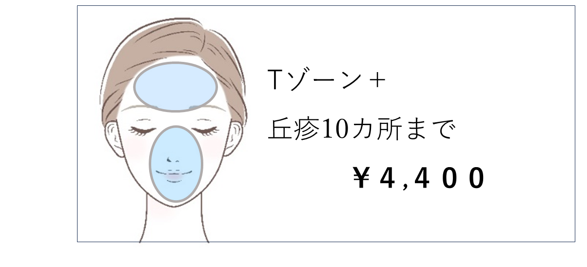 ブルーレーザー3 ブルーレーザー3