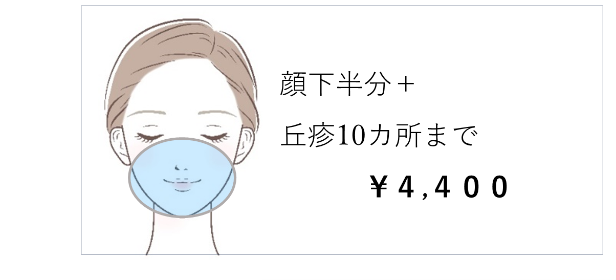 ブルーレーザー4 ブルーレーザー4