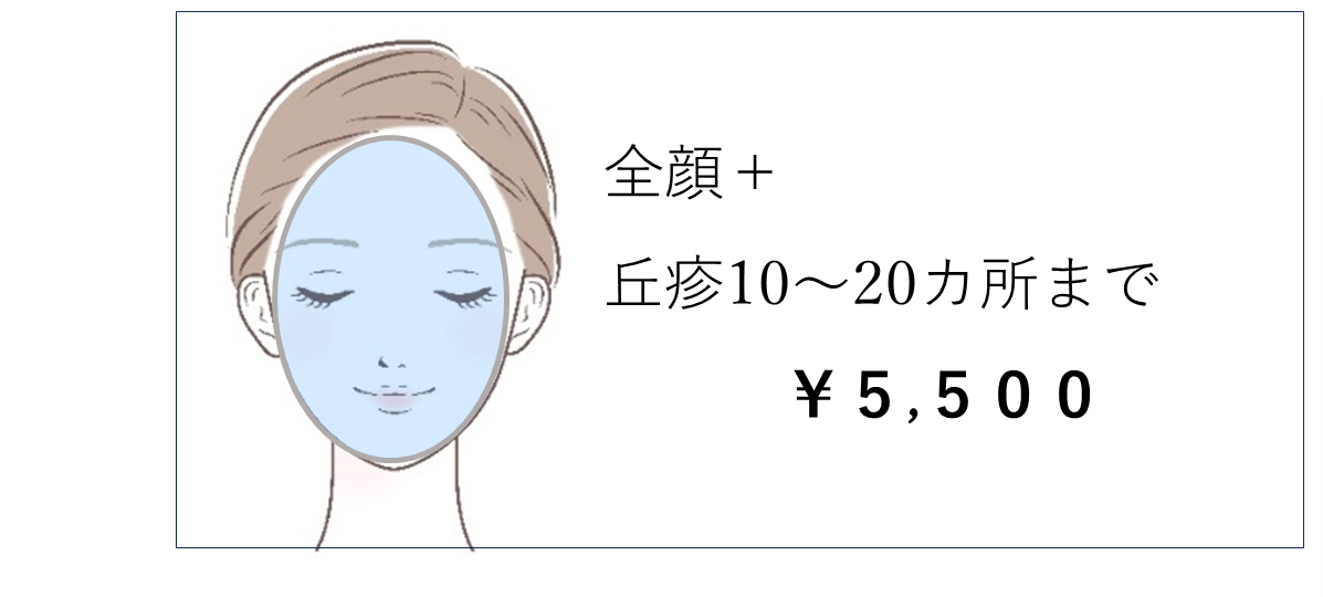 ブルーレーザー5 ブルーレーザー5